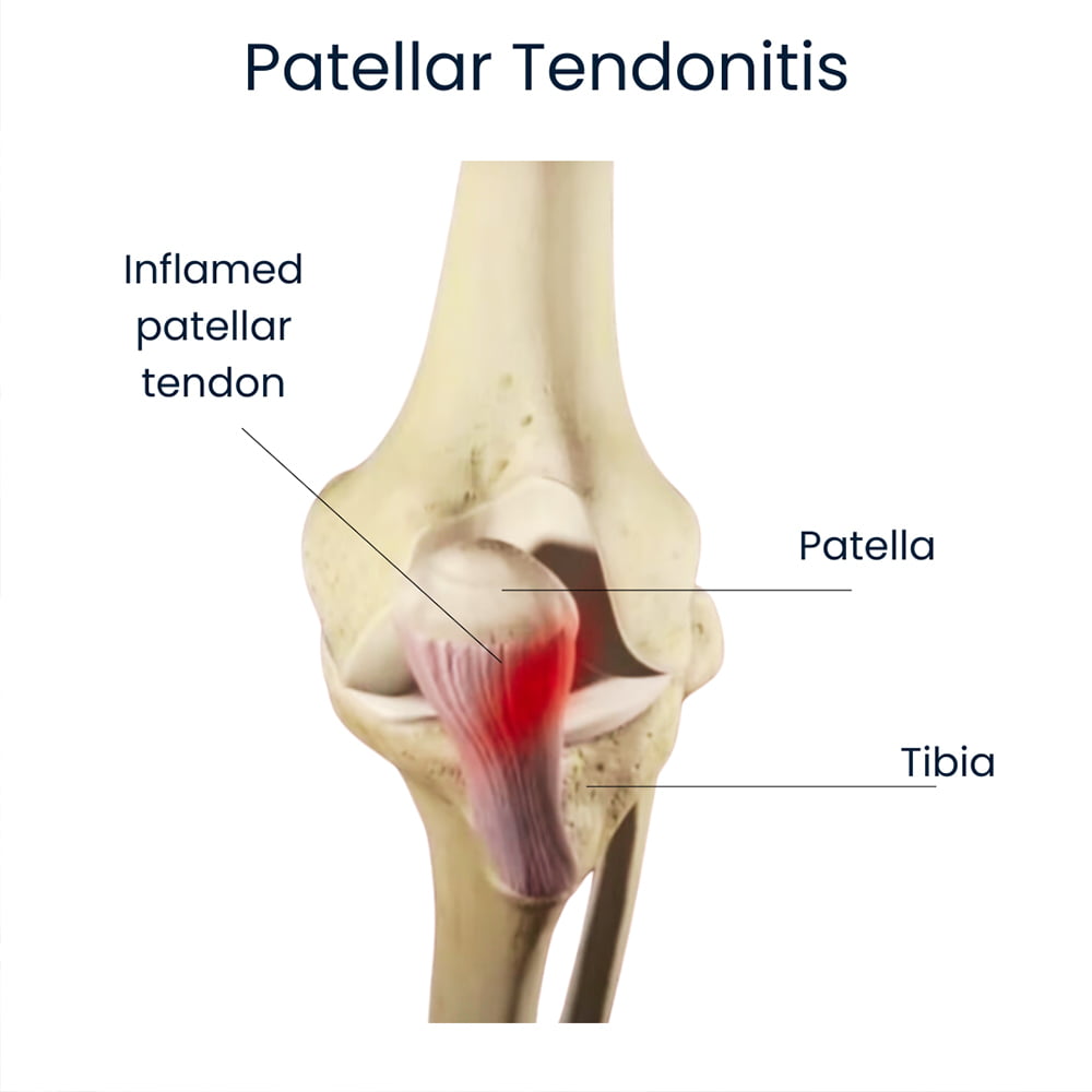 Patellar Tendonitis Treatment NYC