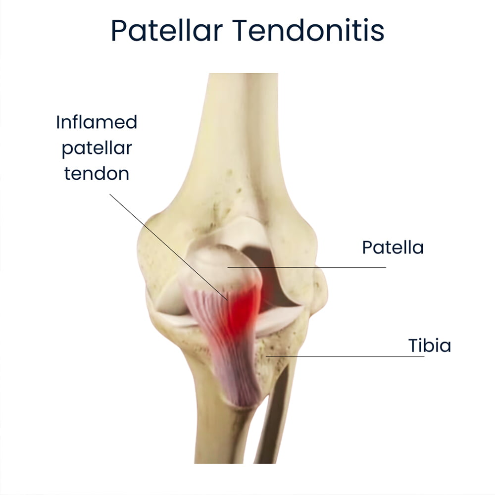 Tendinitis rotuliana