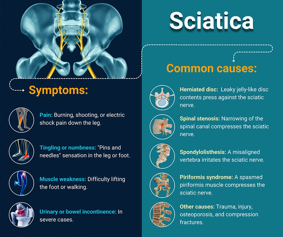 Sciatica Causes