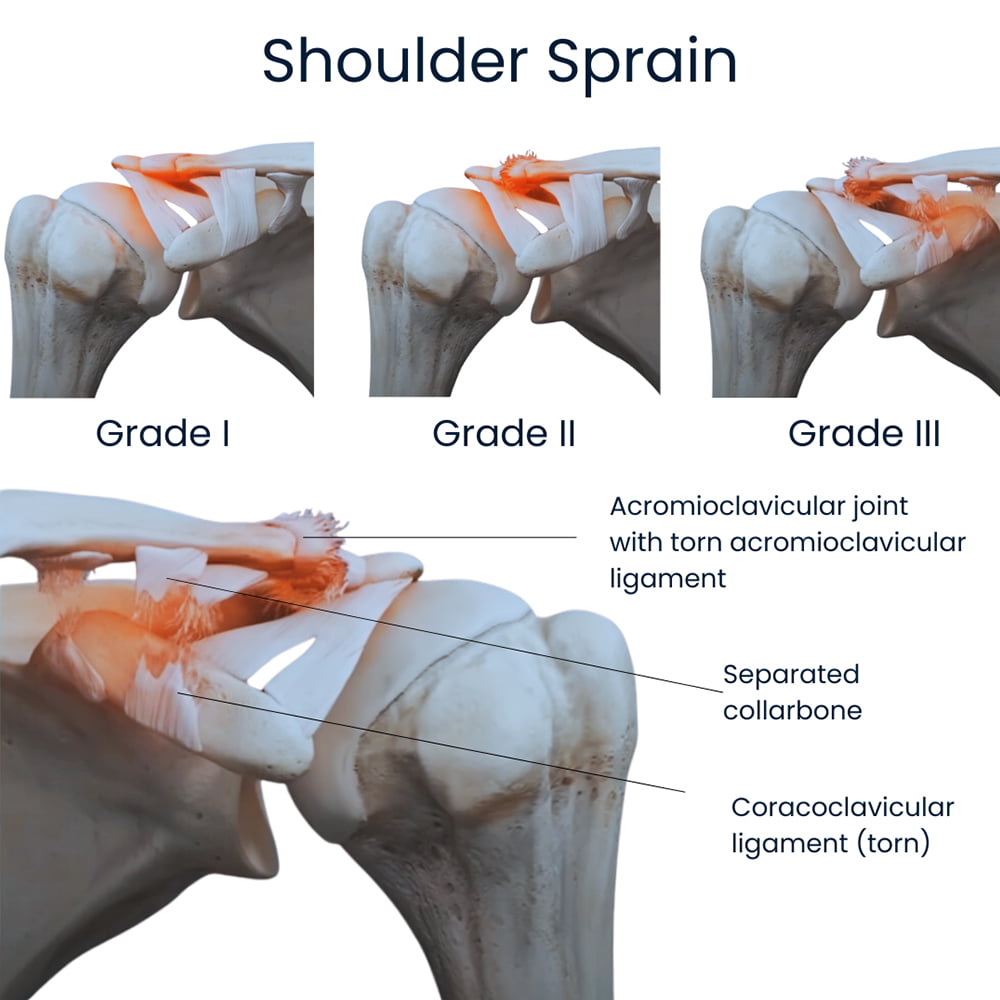 Shoulder Sprain Shoulder Strain