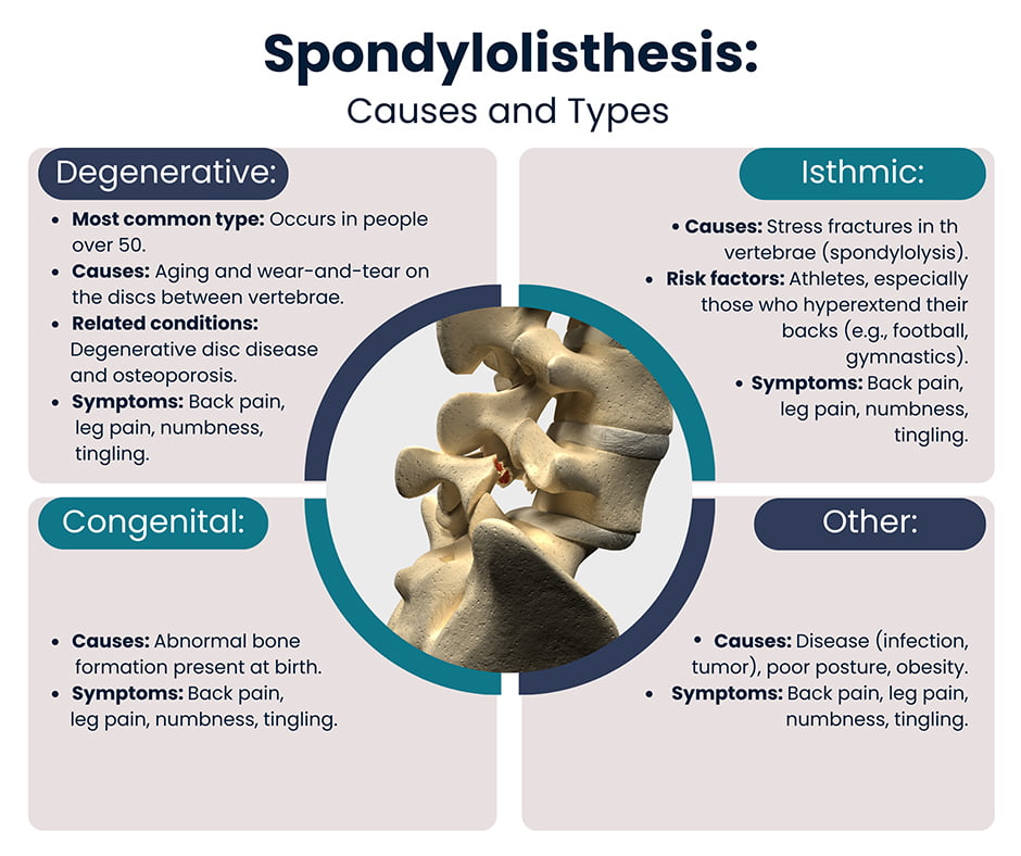 Spondylolisthesis Causes and Types