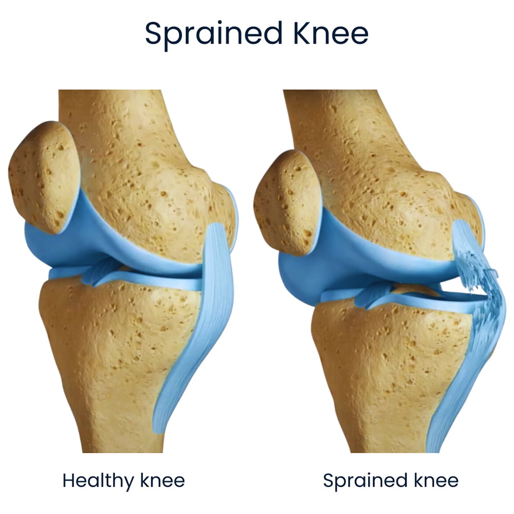 Sprained Knee Anatomy NYC
