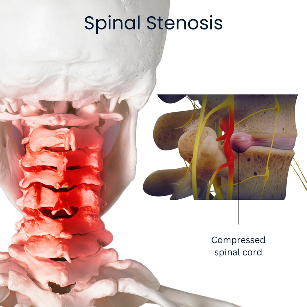 Stenosis of The Neck