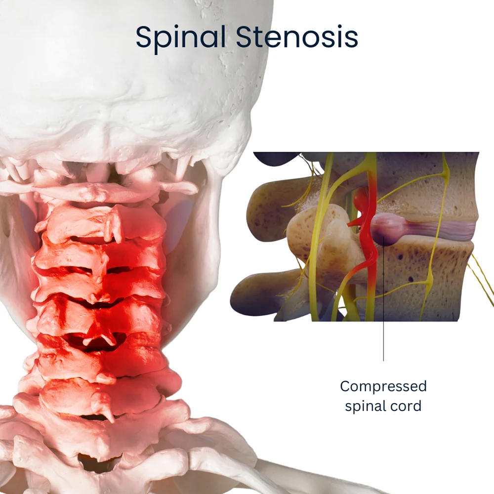 Stenosis of The Neck