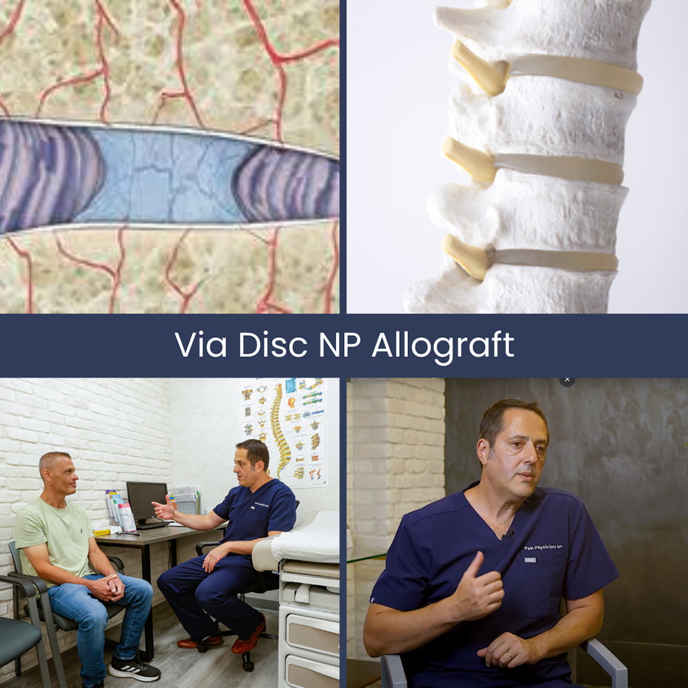 Via Disc NP Allograft Pain Management NYC