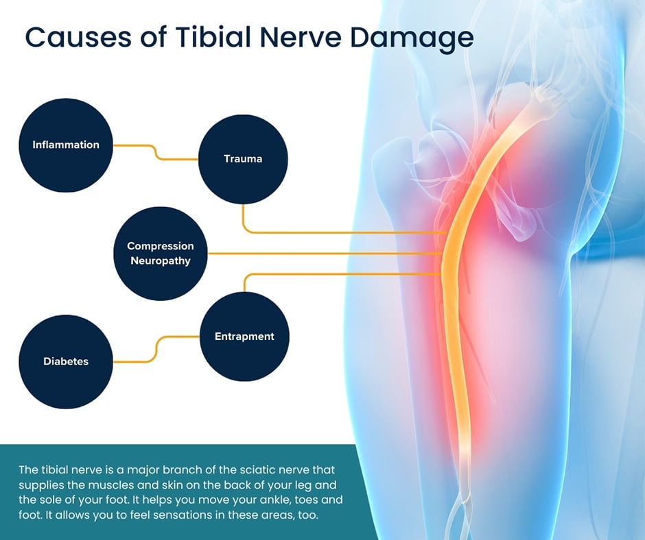 Causes of Tibial Nerve Damage