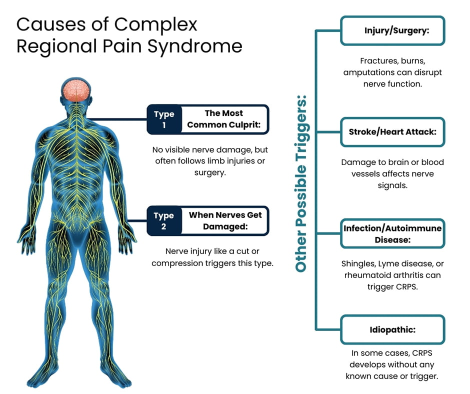 What Causes Complex Regional Pain Syndrome?