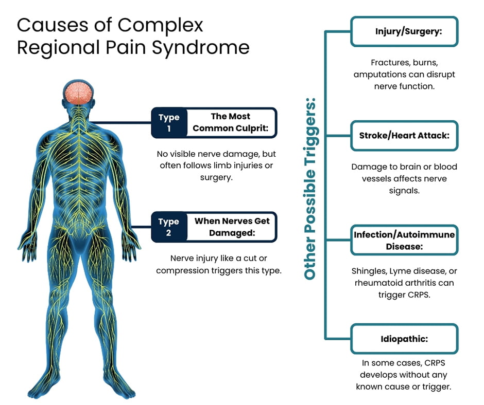 ¿Cuáles son las causas del síndrome de dolor regional complejo?