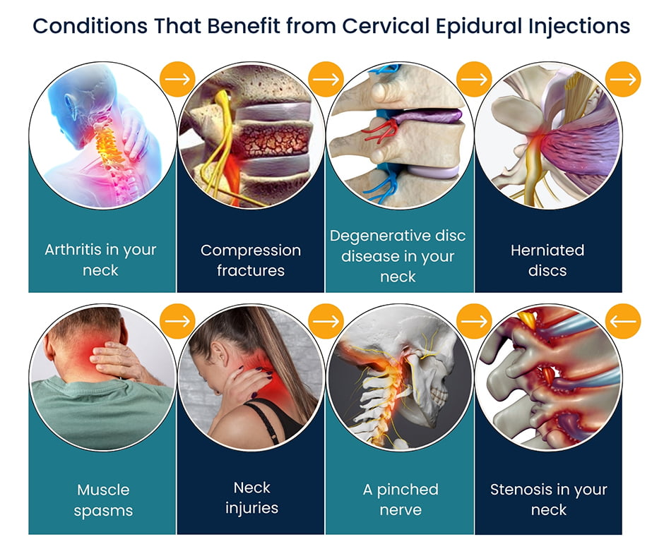Conditions That Benefit from Cervical Epidural Injections