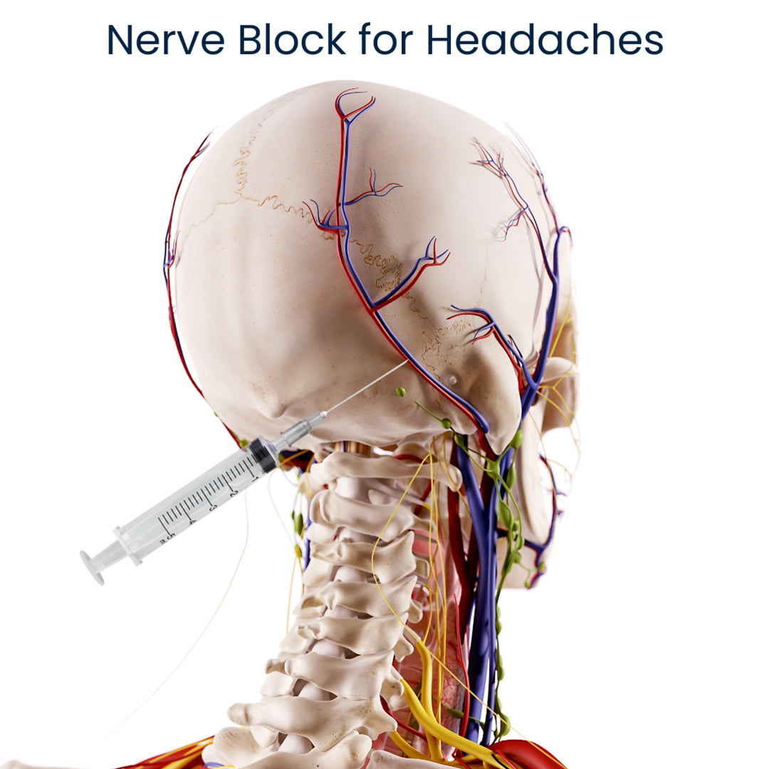 Nerve Block for Headaches