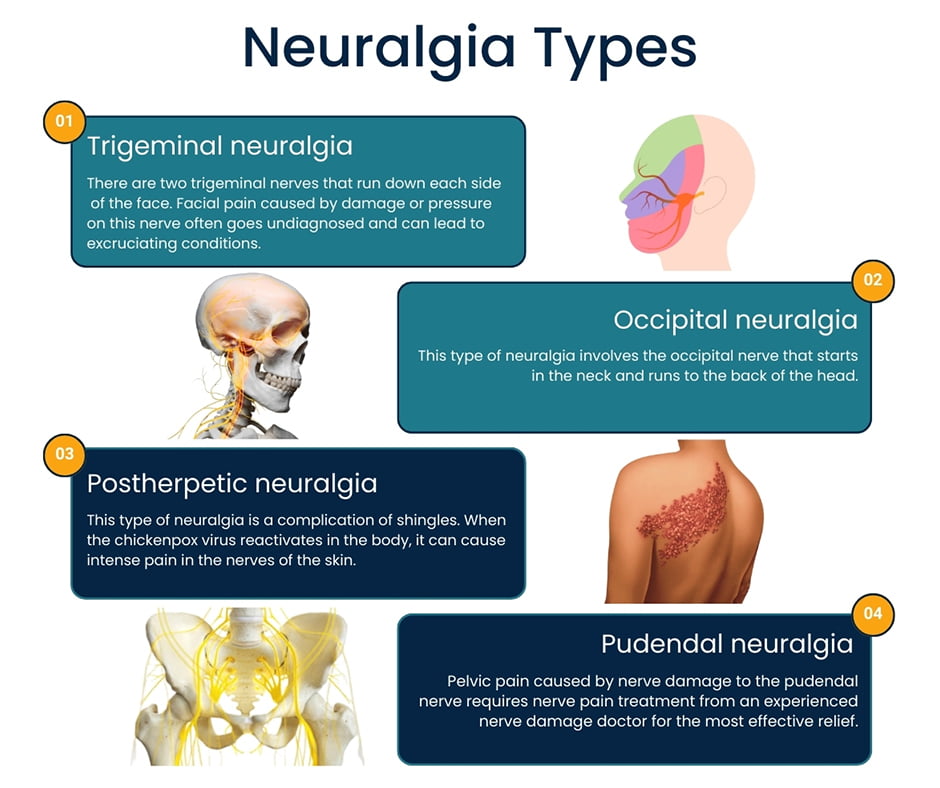 Types of Neuralgia