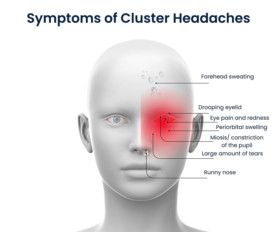 Symptoms of Cluster Headaches