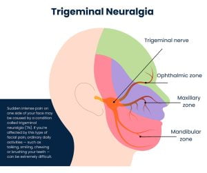 Trigeminal Neuralgia Treatment NYC Facial Pain Specialist New York