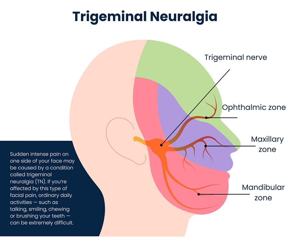 Trigeminal Neuralgia Patient Education National Education