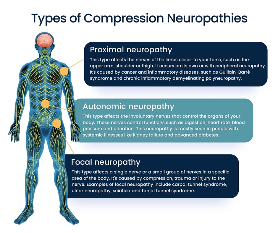 Types of Compression Neuropathy