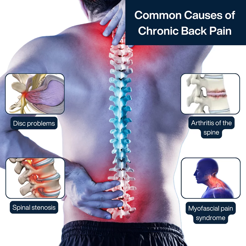 Common Causes Chronic Back Pain