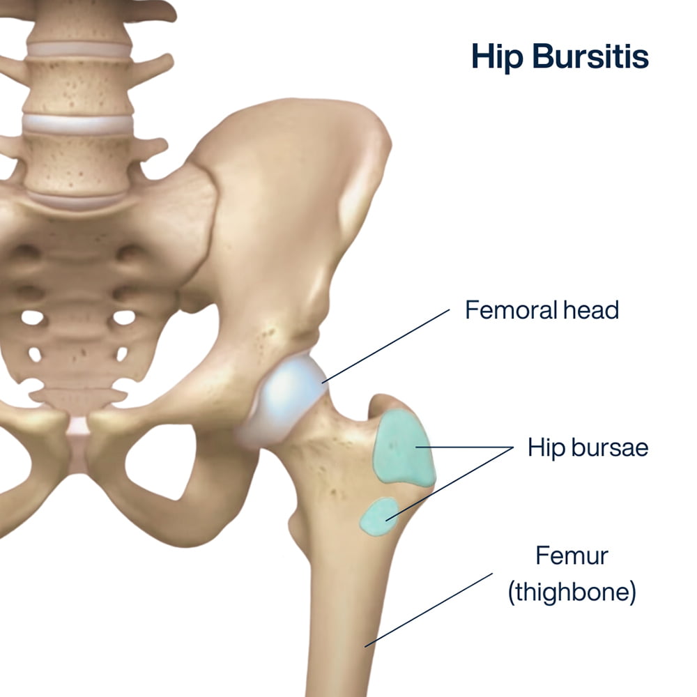 Tratamiento de la bursitis de cadera en NYC