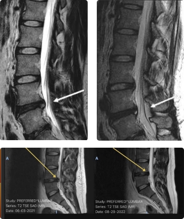 Spine MRI Scan