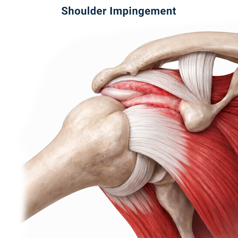 3D orthopedic illustration of subacromial shoulder impingement showing supraspinatus tendon compression, commonly treated at Pain Management NYC