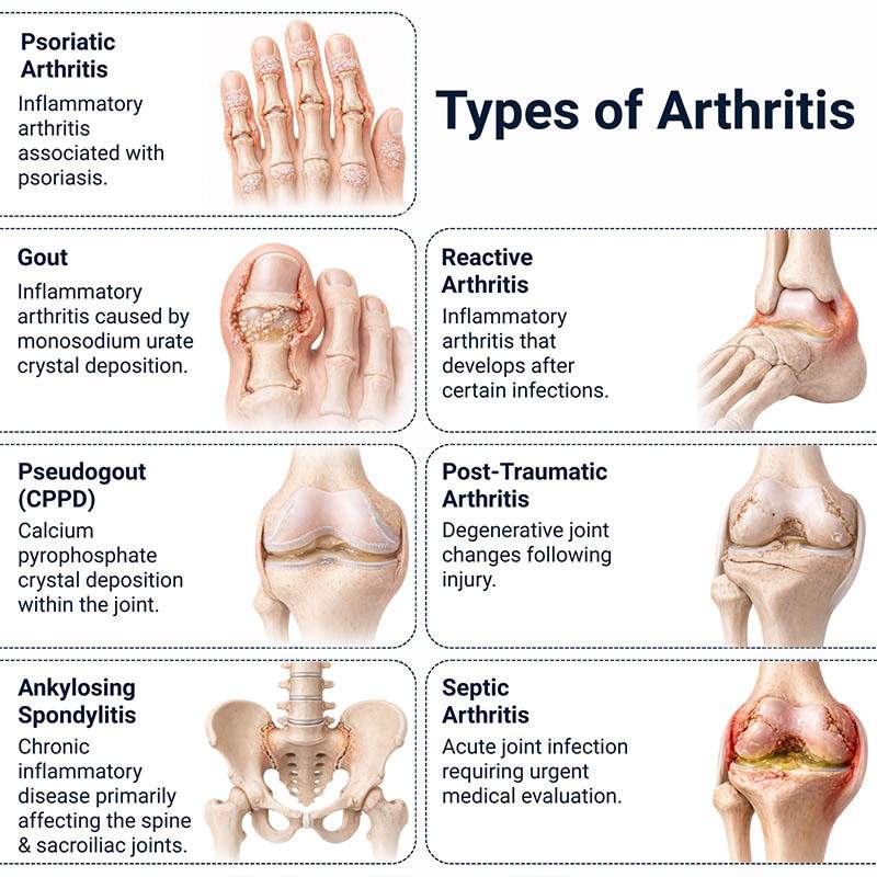 Arthritis Treatment Types NYC Pain Management